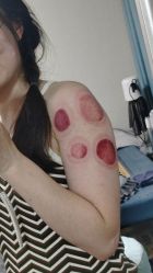 -苗塑堂减肥艾灸