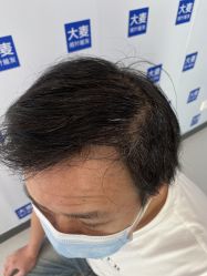 点击看大图 体验后-大麦微针植发全国连锁