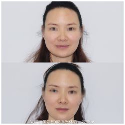 体验后-丽美妍医疗美容·皮秒·立体分层抗衰