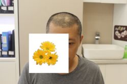 -大麦微针植发丨全国连锁