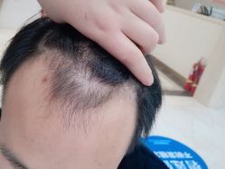 -碧莲盛·不剃发植发