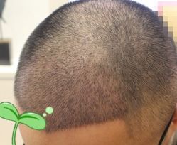 -大麦微针植发丨全国连锁