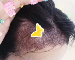 -大麦微针植发全国连锁