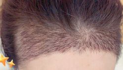 -大麦微针植发丨全国连锁