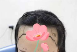 点击看大图 -大麦微针植发全国连锁