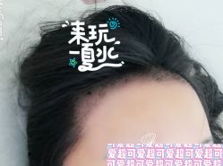 -大麦微针植发全国连锁