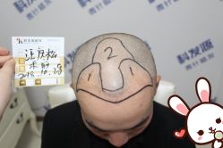 点击看大图 -大麦微针植发丨全国连锁