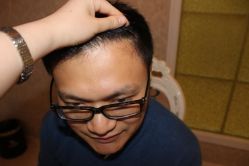 -大麦微针植发丨全国连锁