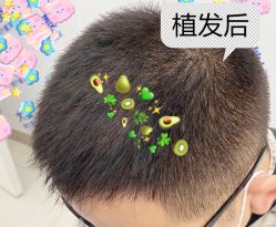 -大麦微针植发全国连锁