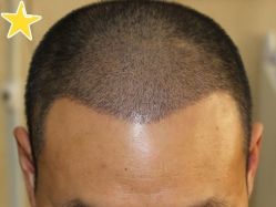 -大麦微针植发丨全国连锁