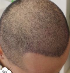 -大麦微针植发丨全国连锁