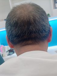 -大麦微针植发丨全国连锁