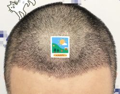 -大麦微针植发全国连锁