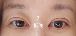 体验后-苏州维多利亚美容医院