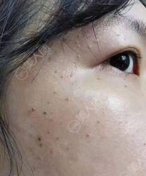 -美人痣全国连锁