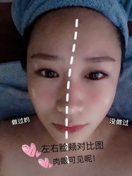 -FACE·日本小颜美容整骨