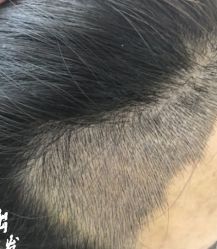 -大麦微针植发丨全国连锁