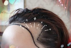 -大麦微针植发全国连锁