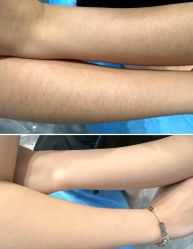 -薇兰专业脱毛连锁机构