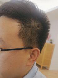 体验后-清疣美疣·痣·斑净肤中心