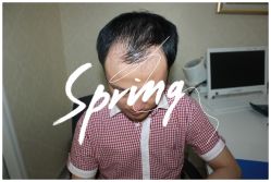 -大麦微针植发全国连锁