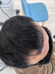 体验后-雍禾植发全国连锁