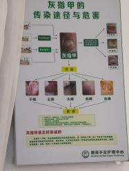 -德哥灰指甲脚气甲沟炎跖疣护理