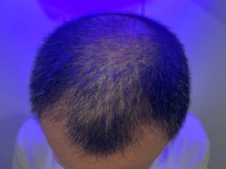 体验后-熙朵美学植发·连锁品牌