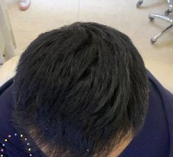 -大麦微针植发丨全国连锁