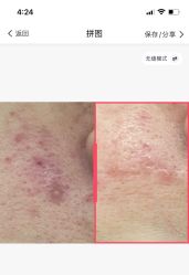 -苗医生0感科技祛痘