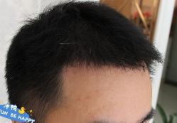 -大麦微针植发丨全国连锁