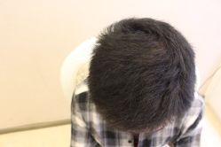 -大麦微针植发丨全国连锁