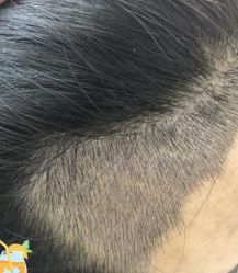 -大麦微针植发丨全国连锁