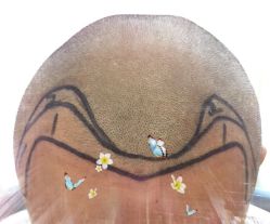 -大麦微针植发全国连锁