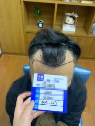 -大麦微针植发全国连锁