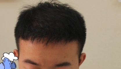 -大麦微针植发丨全国连锁