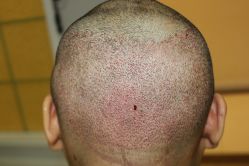 -大麦微针植发丨全国连锁