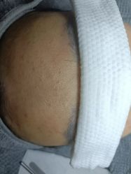 -倩极·精研痘敏肌管理