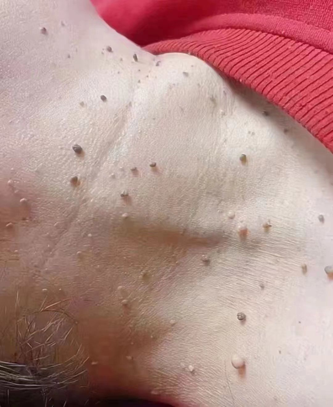 💞"小肉揪"别忽视
疣,别抠,越抠