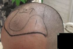 -大麦微针植发丨全国连锁