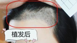 -大麦微针植发全国连锁