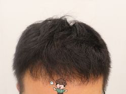 -大麦微针植发全国连锁