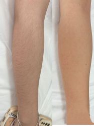 -小梨·OndaPro·专业脱毛连锁机构