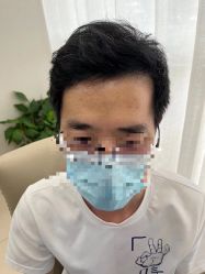 -大麦微针植发丨全国连锁