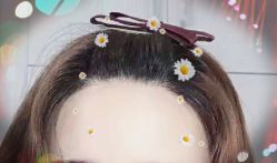 -大麦微针植发全国连锁