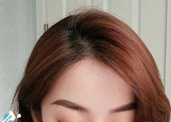 -大麦微针植发丨全国连锁