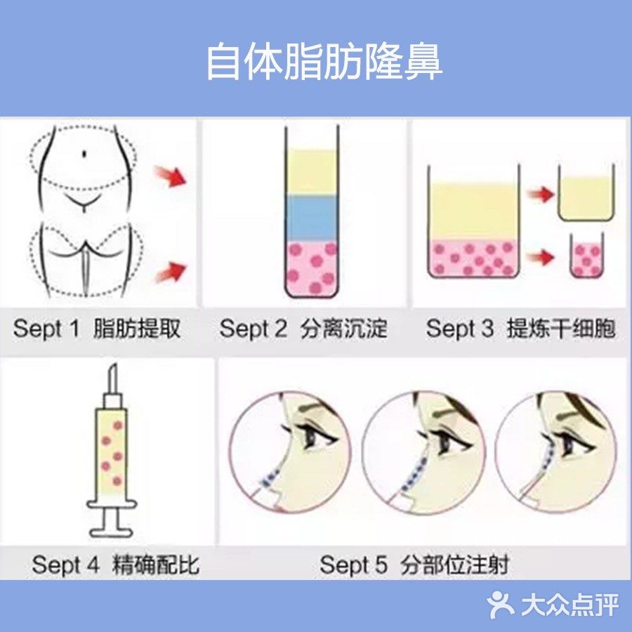 害怕手术的看过来！非手术隆鼻法介绍～