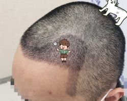 -大麦微针植发全国连锁