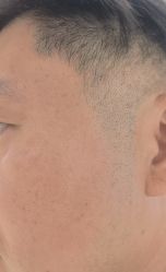 -美丽人生祛斑扁平疣汗管瘤中心