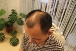 -大麦微针植发丨全国连锁